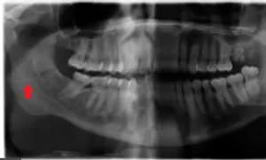 Bác sĩ làm kẹt kim tiêm trong miệng bệnh nhân khi nhổ răng